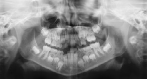  Dental Radiographs (X-Rays) - Pediatric Dentist in Greer, SC