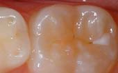 Sealant-Before - Pediatric Dentist in Greer, SC